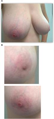 Paget’s Breast Disease: A Case Report and Review of the Literature